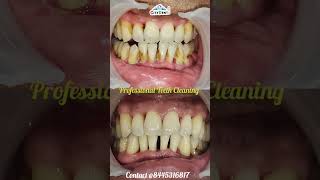 NO Teeth Cleaning DOES NOT weaken tooth dentistnearbydentalclinicrudapurcleaningshortsvideo [upl. by Llebasi]