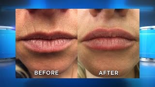 New Lip Filler Results [upl. by Sanburn]