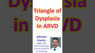 Triangle of Dysplasia in Arrhythmogenic Right Ventricular Dysplasia ARVD [upl. by Ciapas233]