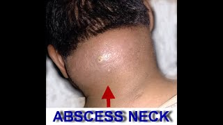 NECK ABSCESS 1 [upl. by Lairea]