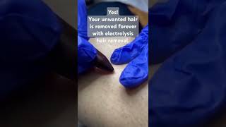 Electrolysis  Permanent Hair Removal Method for unwanted hair unwantedhairremovallaserhairremoval [upl. by Dilahk]