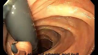 Right Colon Retroflexion [upl. by Ada]