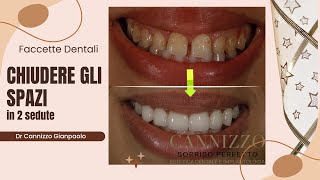 Caso di applicazione di faccette dentali  Cannizzo Studio Milano [upl. by Akvir]