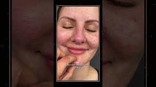 WARNING The “Pillow Face” Epidemic  Filler Face Syndrome  Part 1 facelift [upl. by Nollahs]