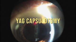 YAG CAPSULOTOMY TAKE A LOOK TO THE TECHNIQUE [upl. by Aznaed]