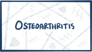 Osteoarthritis  causes symptoms diagnosis treatment amp pathology [upl. by Nilkcaj451]