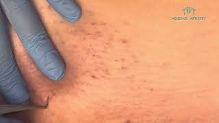 Ingrown Hair Extractions  Move  Episode 36 [upl. by Katzman]