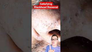 Crazy BLACKHEAD REMOVAL  Blackhead Extraction shorts [upl. by Nadaha]