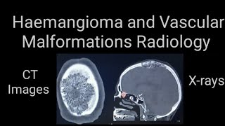 Hamangioma and vascular malformations Radiology Xrays and CT images [upl. by Rellia]