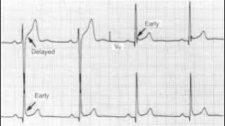 Podcast 846 Early Repolarization vs Anterior STEMI [upl. by Eidnac536]