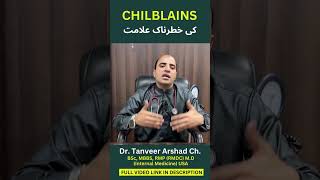 What are the danger signs of chilblains  چلبلینز کے خطرے کی علامات؟  Dr Tanveer Arshad Ch [upl. by Bully]