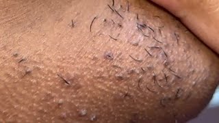 INGROWN HAIR REMOVAL 114 [upl. by Karrah]