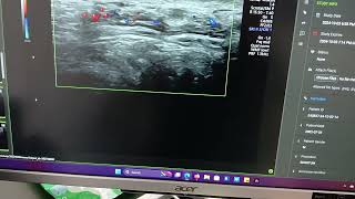 Pampiniform plexus Cyst  Ultrasound  Sonography [upl. by Llahsram388]