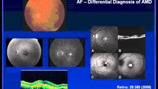 Utilizing Autofluorescence in AMD [upl. by Ahsieyt]