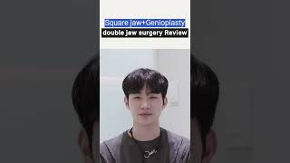 1 Year PostOp Review of Double Jaw Surgery for Male Lantern Jaw and Facial Asymmetry [upl. by Sager626]