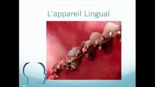 Orthodontie linguale comment survivre  Tutorial HQ [upl. by Lengel953]