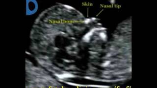 Fetal Medicine Foundation  Nasal bone [upl. by Notnef]