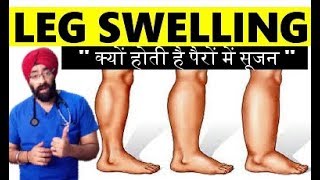 Q LEG SWELLING Pairon me soojan kyon hoti hai Pedal edema Reasons explained by DrEducation [upl. by Frere]