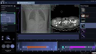 Pulmonary Angio Triger and start  radiology ctscan angiogram [upl. by Hnilym]