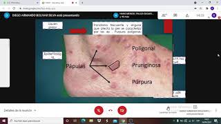 Dermatología liquen plano [upl. by Culhert]