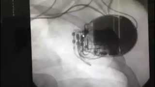 Video 531  Interventional Cardiac Electrophlysiology [upl. by Guimar]