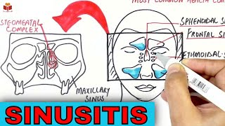 What is Sinusitis  Causes Symptoms amp Treatment [upl. by Ritz]