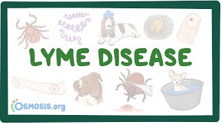 Lyme disease  causes symptoms diagnosis treatment pathology [upl. by Ojok]