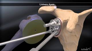 Apex Total Shoulder Arthroplasty Systems [upl. by Bum]