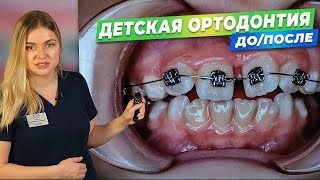 Детская ортодонтия Результат лечения ДОПОСЛЕ [upl. by Trudi395]