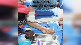 AVF Cannulation techniques  Dialysis patient cannulation dcdc ttt [upl. by Willin477]