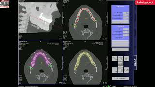 Dental CT Scan Technique in Hindi  ctdantalscan Radiologydept ctscan cttheeth opg cbct [upl. by Mossolb449]