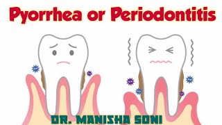 Pyorrhea  Periodontitis  Causes  Symptoms  Treatment [upl. by Amargo873]