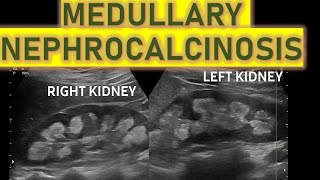 BILATERAL MEDULLARY NEPHROCALCINOSIS ON USG  And its causes [upl. by Ennairej]