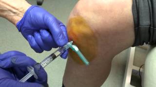 Norwich Podiatrist  Ostenil Plus injection of the knee  part 2 [upl. by Ivah]