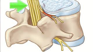 Cervical spondylosis disease treatment in homeopathycervical spondylosis without myelopathy [upl. by Raf826]