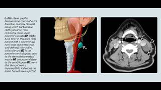 Branchial cystㅣthyroglossal cystㅣthornwaldt cyst radiology [upl. by Akcira]