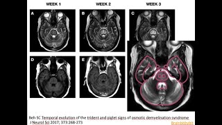 45 Osmotic demyelination syndrome ODS pontine myelinolysis hyponatriemia correction piglet sign [upl. by Burnley]