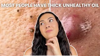 How To Treat Every Type of Acne Comedones Nodules Cysts [upl. by Theresa167]