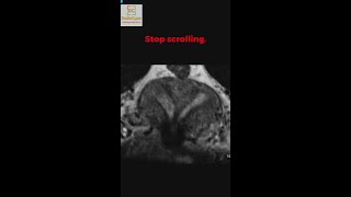 Comment your Answer MRI Pelvis  Quiz Case [upl. by Laban]