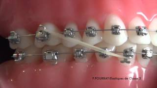 Les élastiques de Classe 3 en technique orthodontique vestibulaire [upl. by Yuille452]