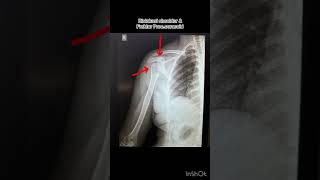 Dislokasi shoulderfracture proc coracoid xray radiology röntgen patahtulang [upl. by Ynnij]