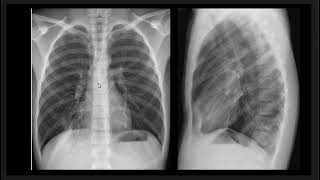 Case Discussion  Mycoplasma Pneumonia [upl. by Odraude]