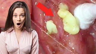 How to Remove Tonsil Stones You Cant See with 8 Remedies [upl. by Alexandr]