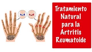 ARTRITIS REUMATOIDE TRATAMIENTO NATURAL  Tratamiento natural de la artritis reumatoidea [upl. by Nevaed546]