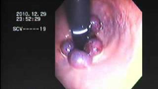 haemorrhoid banding BY DR NASEEM GHOURI [upl. by Nart]