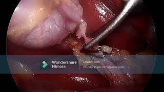 LAPAROSCOPIC CHOLESYSTECTOMY [upl. by Rolyks]