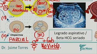 ENFERMEDAD TROFOBLÁSTICA GESTACIONAL QX MEDIC [upl. by Kyd]