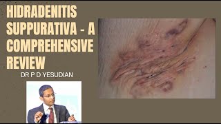 Hidradenitis suppurativa  a comprehensive review of all treatments [upl. by Tiphany]