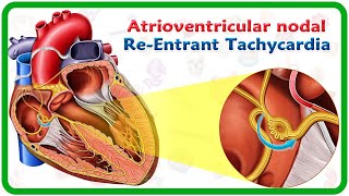 Atrioventricular nodal reentrant tachycardia AVNRT  USMLE [upl. by Prasad]