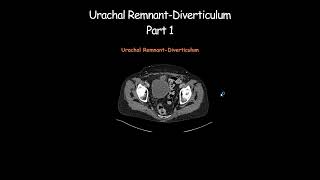 Urachal RemnantDiverticulum Part 1 radiology radiologist embryology urinarybladder [upl. by Gluck]